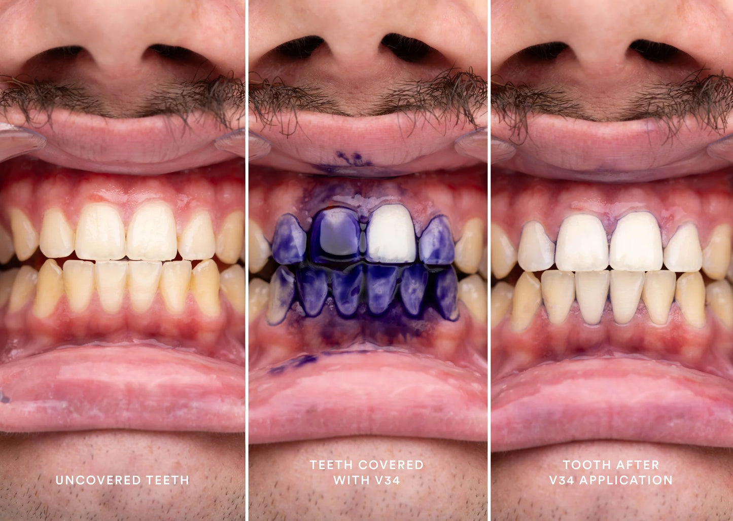 V34 Purple Blanqueador dental